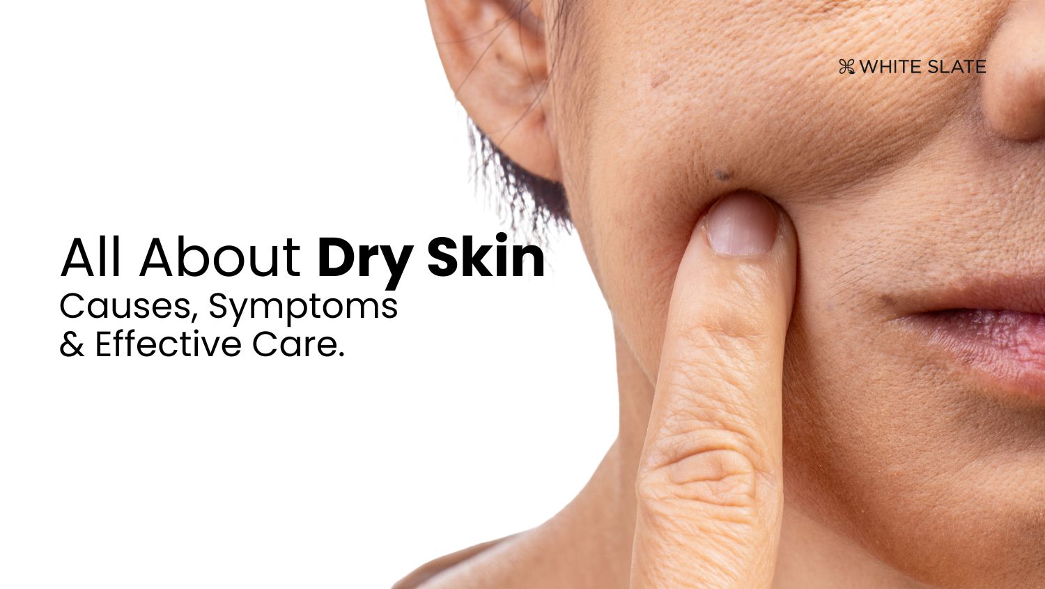 All About Dry Skin: Causes, Symptoms, and Effective Care – WHITE SLATE