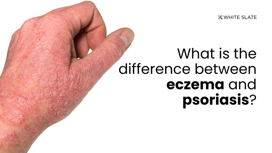 eczema and psoriasis