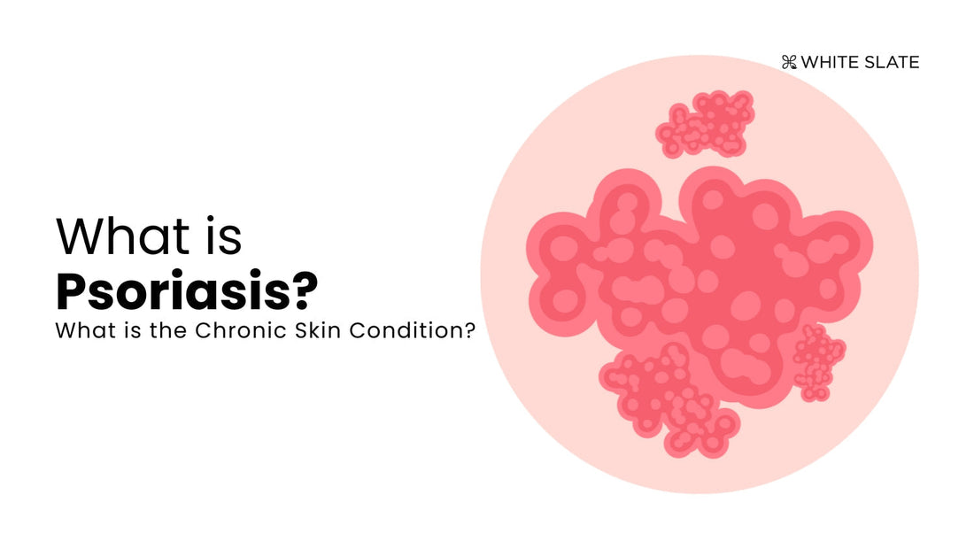 Psoriasis