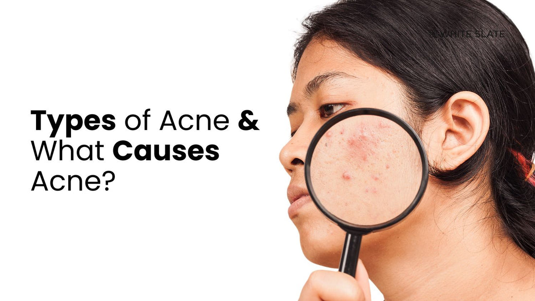 Types of Acne & What Causes Acne