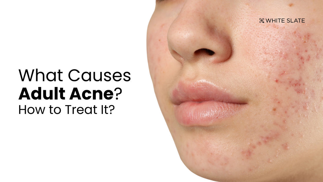 Adult Acne