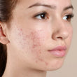 Acne Prone